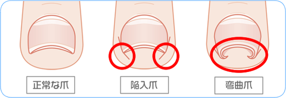 巻き爪