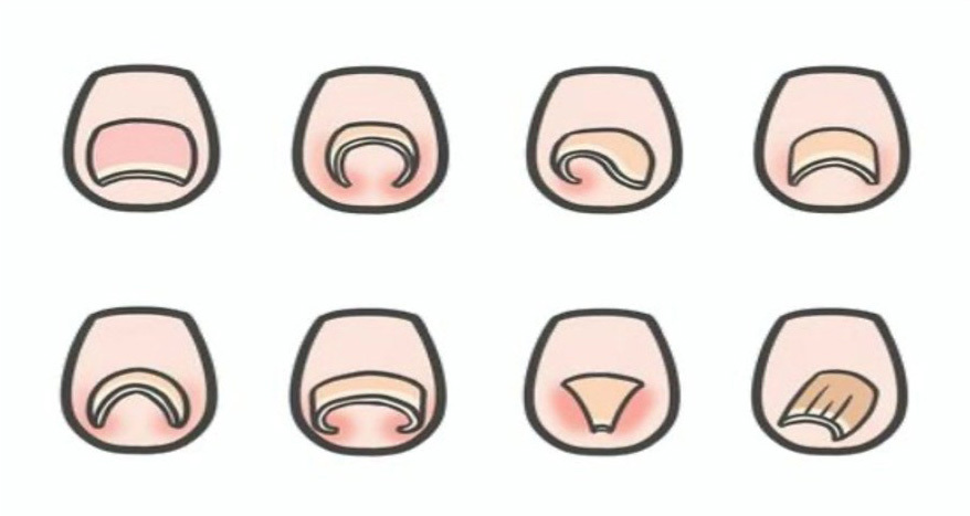 巻き爪